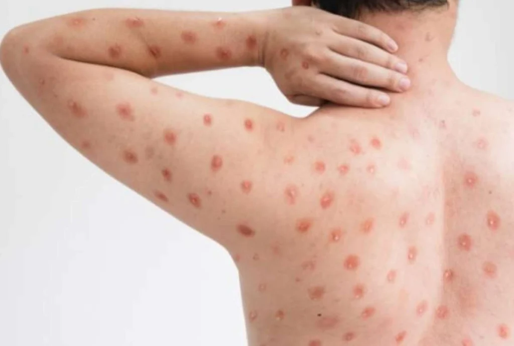 Ecuador confirma primer caso de viruela símica Clado Ib Ecuador confirma primer caso de viruela símica Clado Ib